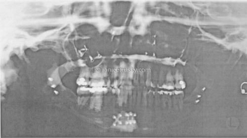 panorama%20x-ray (thumbnail)