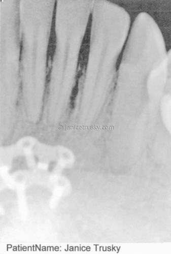 front%20lower%20%20x-ray (large view)