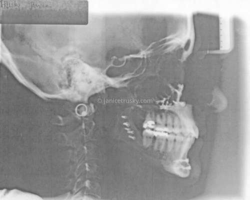 profile%20xray (large view)
