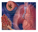 Illustration-Chronic Obstructive Pulmonary Disease, COPD,  Bronchitis in Smokers, Lungs, Alveoli, Bronchioles, Infection