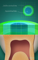 Illustration-Dentin Bond Strengths of Simplified Adhesives
