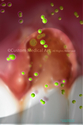 Illustration-Subepithelial Connective Tissue Grafting Procedure