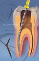Illustration-Nickel Titanium Rotary or Stainless Steel Hand File Instrument Techniques