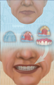 Illustration-Rehabilitation of Failing Teeth with Denture Prostheses