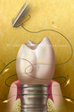 Illustration-Root Caries in Relation to Patient Compliance