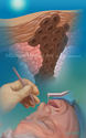 Illustration-Skin Cancer Found During Dental Check Up