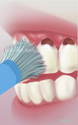 Illustration-Tooth Abrasion from Brushing