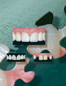 Illustration-Tooth Bridges
