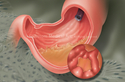 Illustration-Hypergastronemia, ESRD, Internal View of Stomach, Ulcer, Mucous