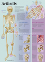 Illustration-Arthritis Patient Education Poster