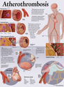 Illustration-Atherothrombosis Patient Education Poster