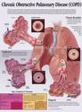 Illustration-Chronic Obstructive Pulmonary Disease Patient Education Poster