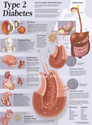 Illustration-Type 2 Diabetes Patient Education Poster
