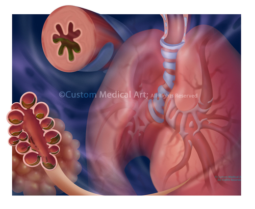 Illustration-Chronic Obstructive Pulmonary Disease, COPD,  Bronchitis in Smokers, Lungs, Alveoli, Bronchioles, Infection