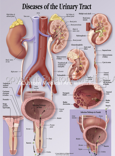 Illustration-Diseases of the Urinary Tract Patient Education Poster
