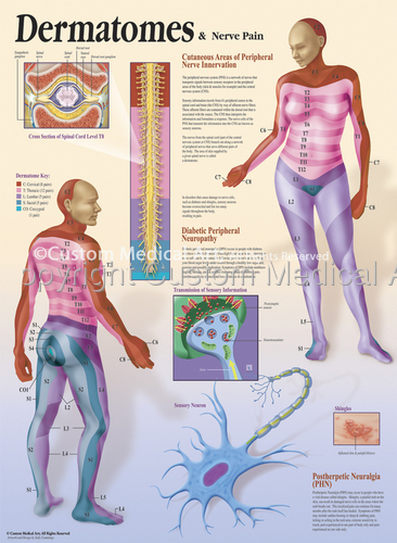 Illustration-Dermatomes & Nerve Pain Patient Education Poster