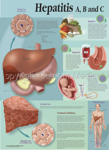 Illustration-Hepatitis A, B and C Patient Education Poster